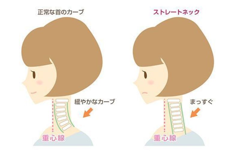 ストレートネック